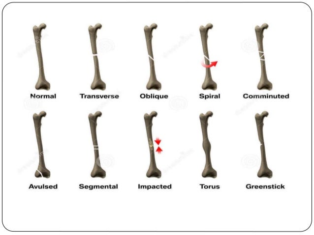 Fracture types - Plaster Of Paris tecniques and Complications