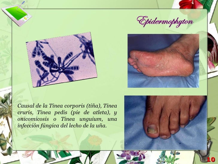 Como sanar el hongo de las uñas por el yodo y la sal