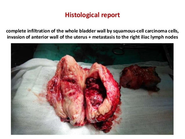 2019 year - Life After Bladder Cancer Surgery 2019 year