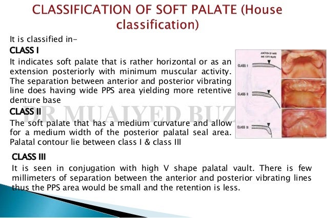 posterior palatal seal