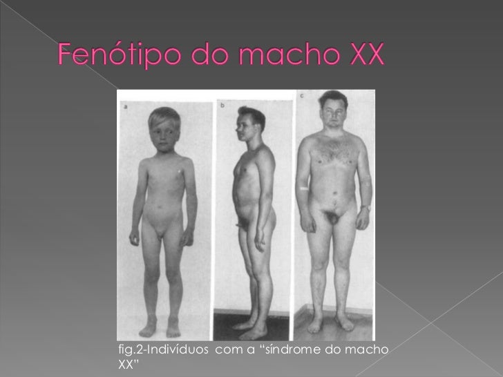klinefelters syndrom klinefelters syndrom