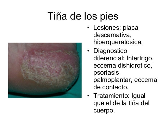 Los sanatorios el tratamiento eficaz de la psoriasis
