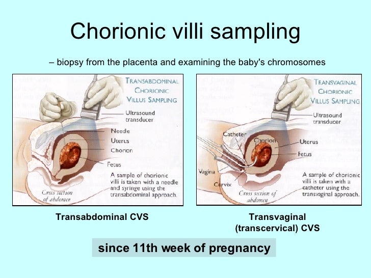 chorionic villus sampling chorionic villus sampling