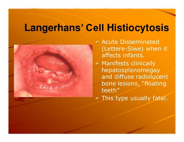 Premature exfoliation of primary teeth
