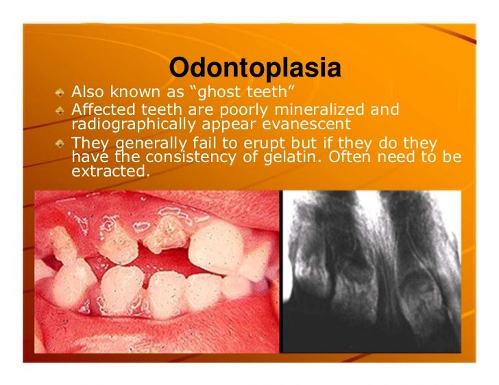 Premature exfoliation of primary teeth