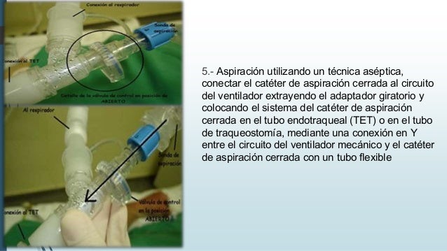 Aspiracion de secreciones