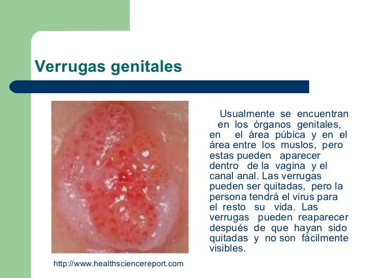 La hernia intervertebral sheynogo del departamento de la columna vertebral que curar