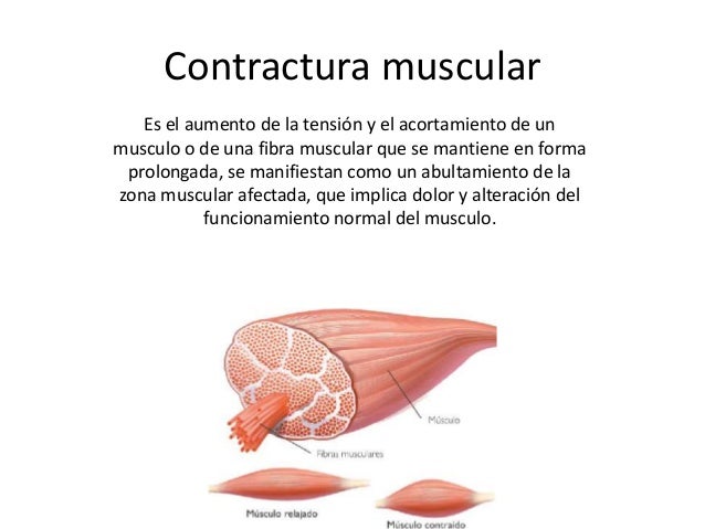 ¿Qué son las contracturas y cómo eliminarlas?