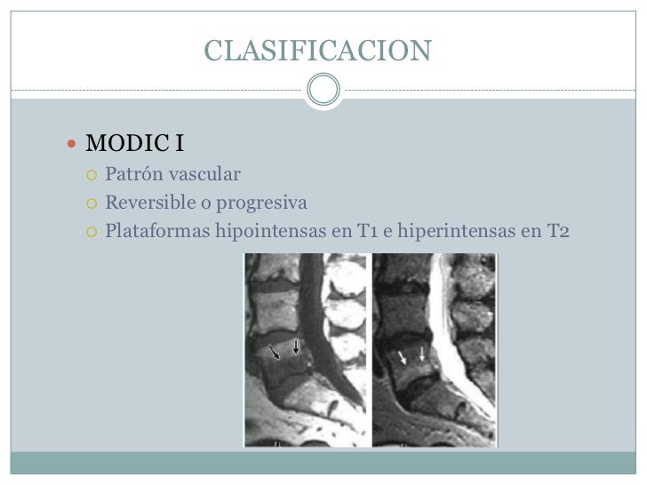 El tratamiento el desplazamiento de las vértebras del departamento lumbar el tratamiento