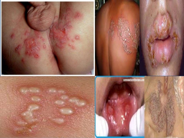 El ungüento sulfúrico de que ayuda la psoriasis
