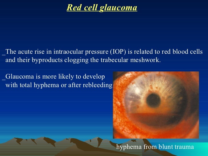 acute intraocular pressure rise