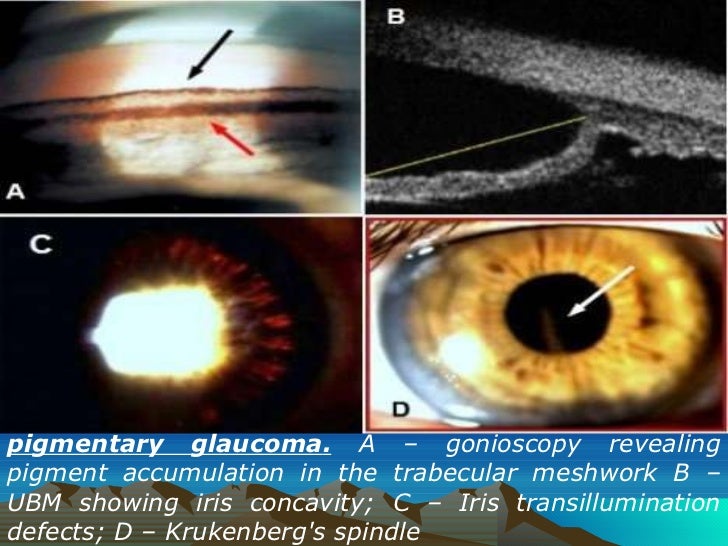 acute intraocular pressure rise