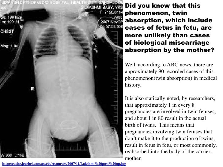 bio wiki Twin Absorption
