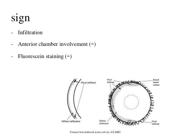Contact Lens-Induced Acute Red Eye(CLARE)