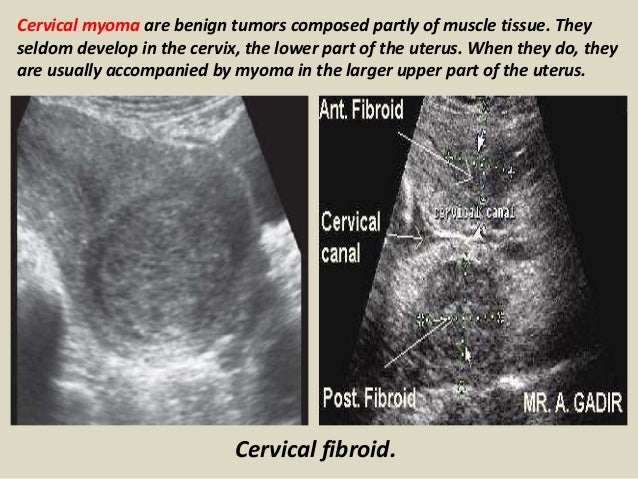 Presentation1.pptx, ultrasound examination of the uterus and ovaries.