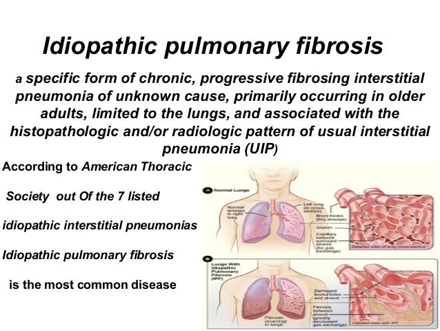 Interstitial Lung Diseses And Idiopathic Pulmonary Fibrosis Interstitial Lung Diseses And Idiopathic Pulmonary Fibrosis