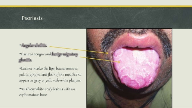 Lesion Patch Red Tongue White