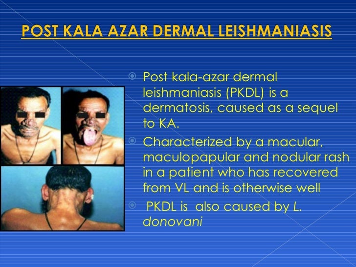 post kala azar dermal leishmaniasis post kala azar dermal leishmaniasis