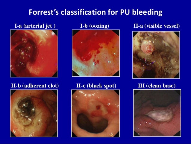 2019 year - What Is a Peptic Ulcer 2019 year