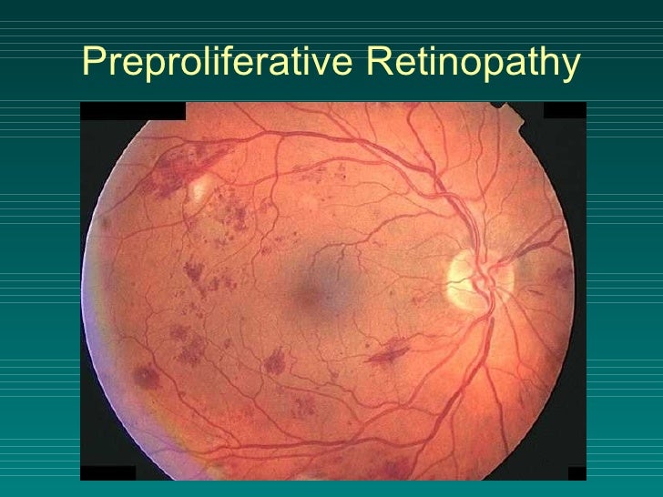 proliferative diabetic retinopathy