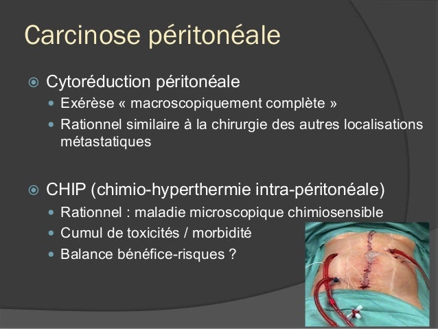 Radiothérapie Stéréotaxique Principe