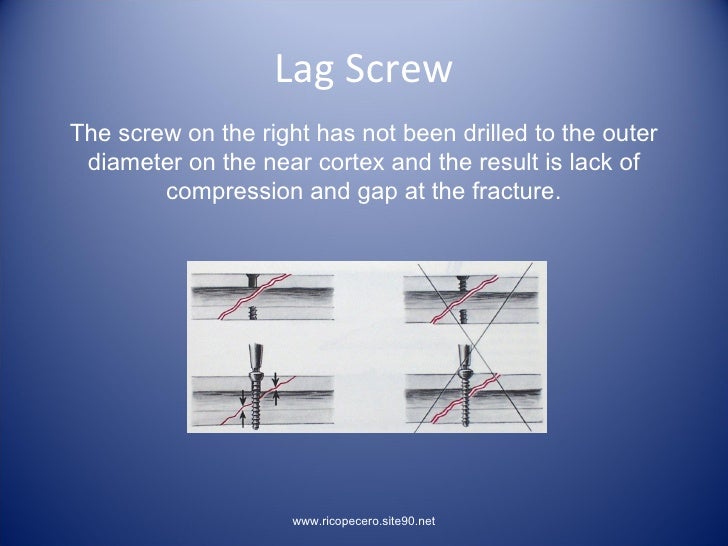 lag screw osteosynthesis lag screw osteosynthesis