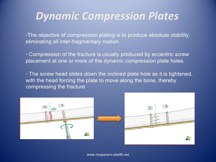 Principles Of Lag Screw + Platting