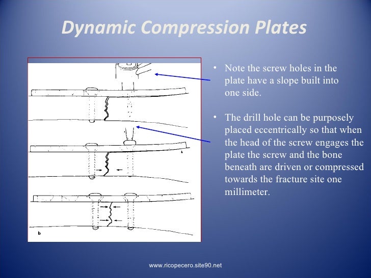 Principles Of Lag Screw + Platting