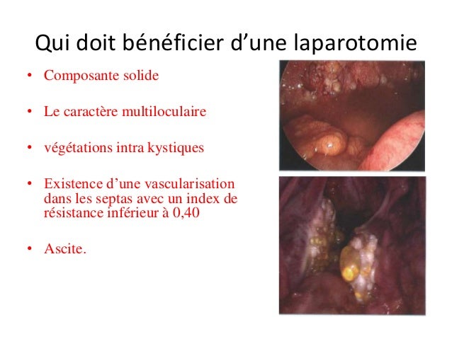 Traitement chimiothérapie poumon chimio avant opération
