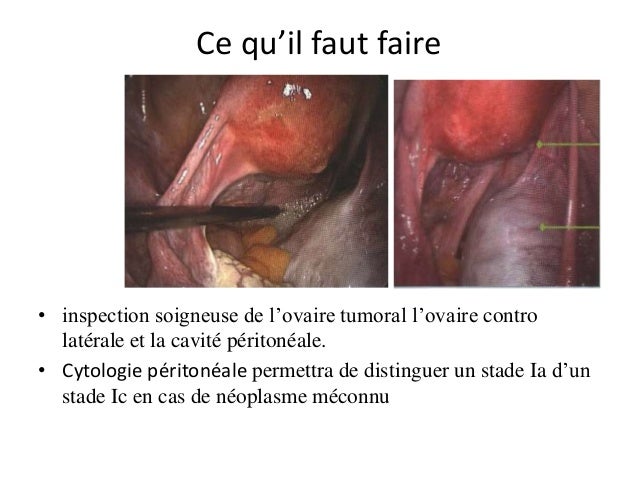 Cancer Ovaire Avec Ascite