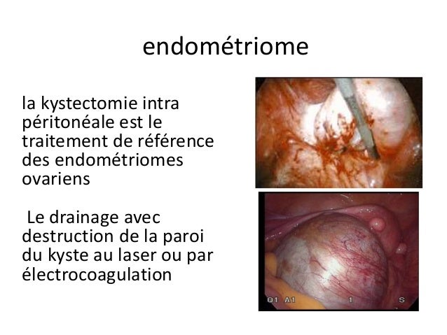 Cancer Ovaire Recidive