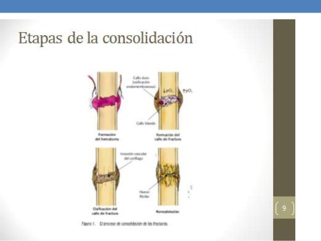 Proceso de reparación y remodelación de fracturas