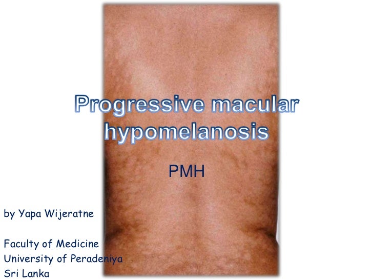 Progressive macular hypomelanosis - Wikipedia