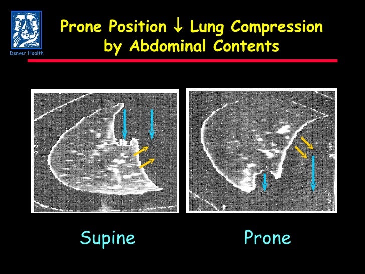 Prone Ventilation In ARDS
