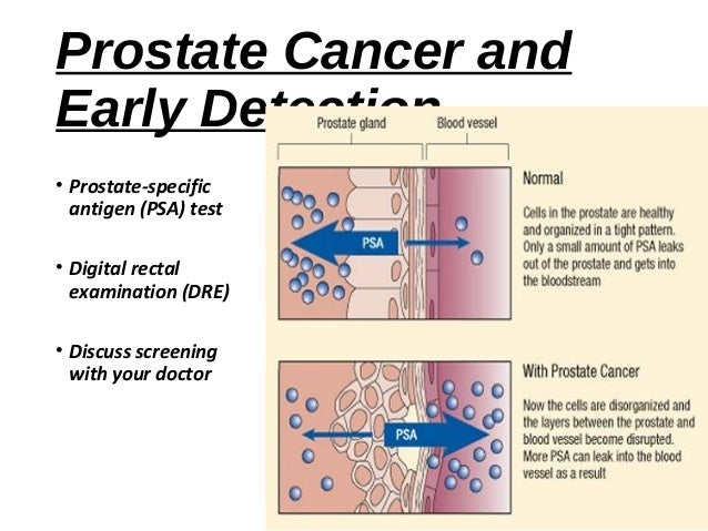 2019 year - Lower your risk of prostate cancer by 70 2019 year