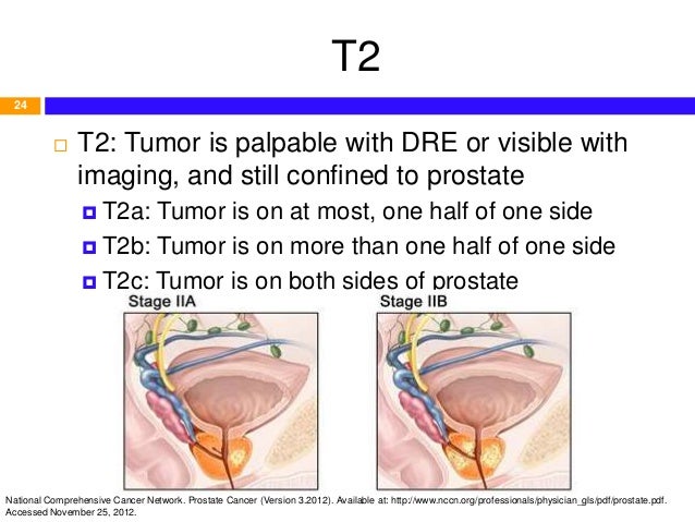 Overview and Pharmacotherapy of Prostate Cancer (based on