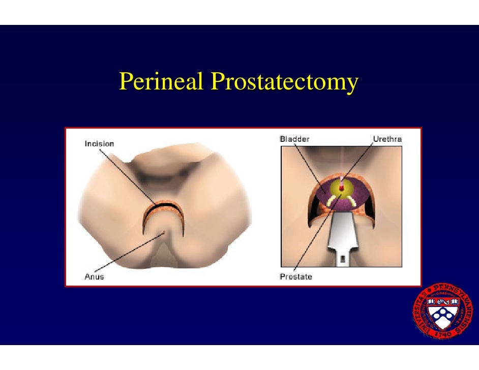 Prostate Cancer Brachytherapy Cialis Daily