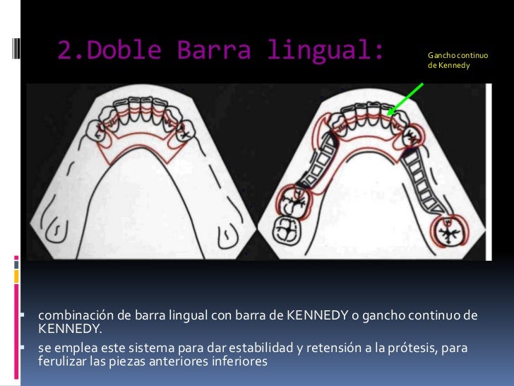 barra lingual superior protesis barra lingual superior protesis