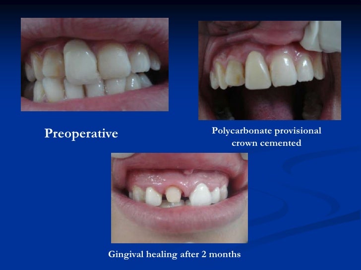 Provisional restorations