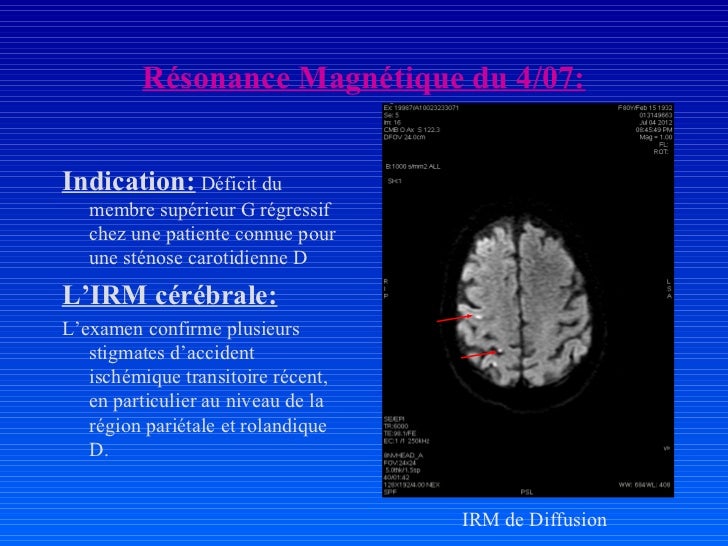 Hypoplasie Du Segment A1 De L'artère Cérébrale Antérieure Droite