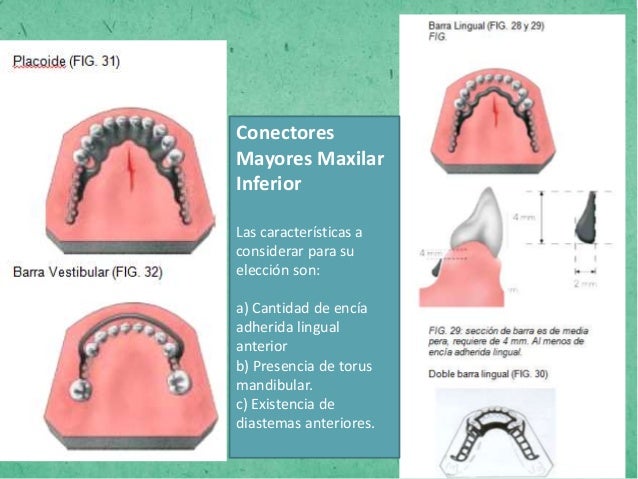 Conectores Mayores De Una Protesis Parcial Removible