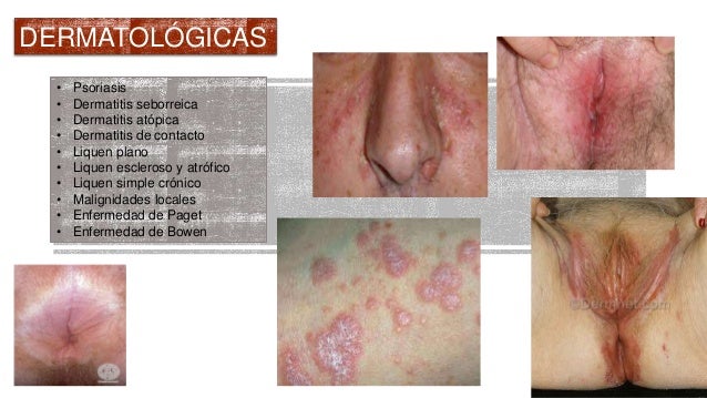 La psoriasis sobre las palmas el tratamiento la crema