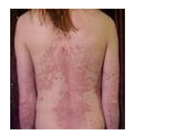 Is psoriasis contagious?