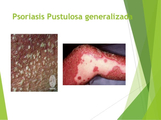 La tintura sobre las setas de la psoriasis