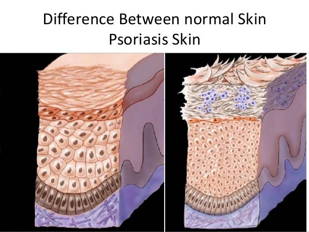 Chronic Plaque Psoriasis. Symptoms, causes and treatment ...