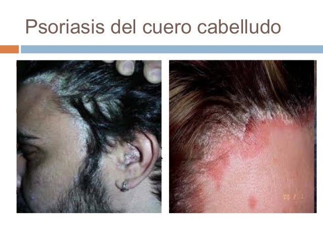 Los sanatorios podmoskovya por el tratamiento de la psoriasis