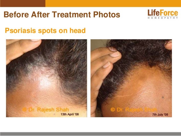 Psoriasis on Scalp &amp; Head Photos Before After Treatment