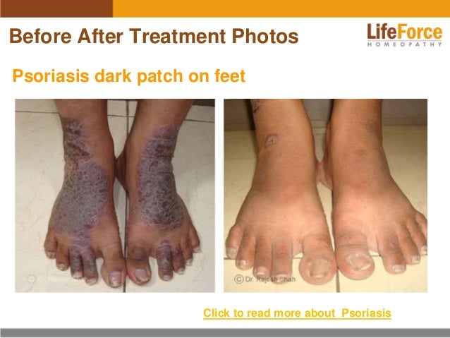Hands, Feet and Nails – National Psoriasis Foundation