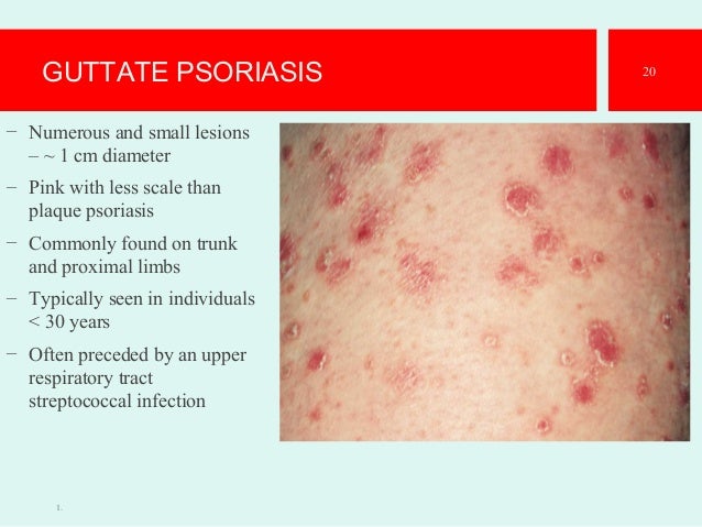 Peri-anale streptococcen dermatitis (perianal ...