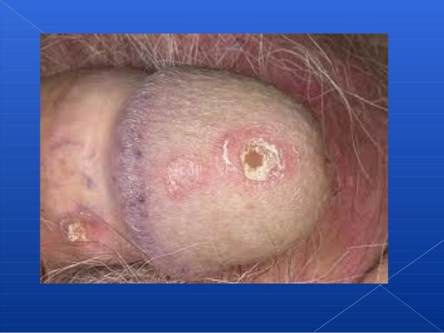 Una alimentación a la psoriasis para el hombre